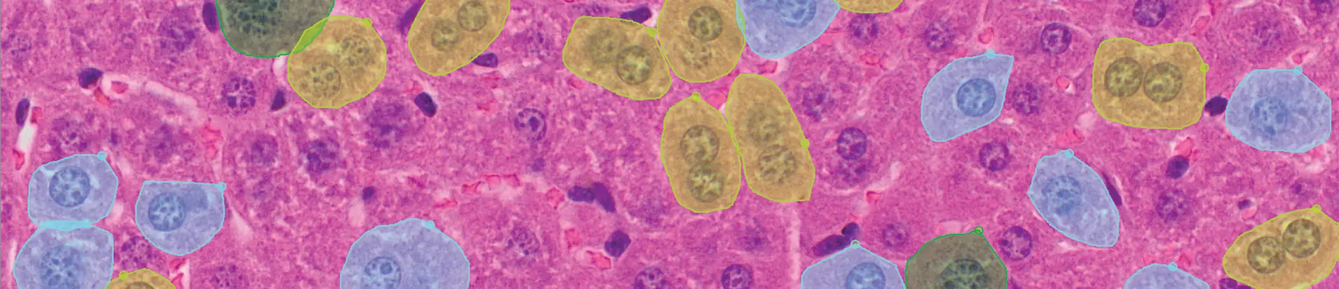 digital pathology sample of cancer cells in blood 