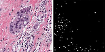 Microscopic view of automated cell detection and tumor cells embedded in stromal tissue with tumor-invading lymphocytes